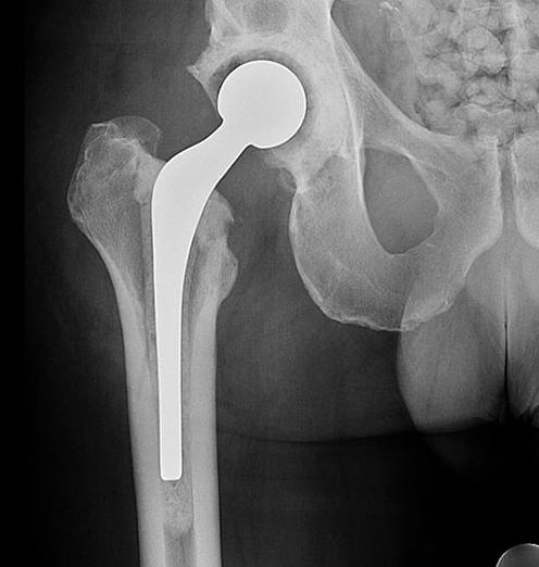 X-Ray THR Infection